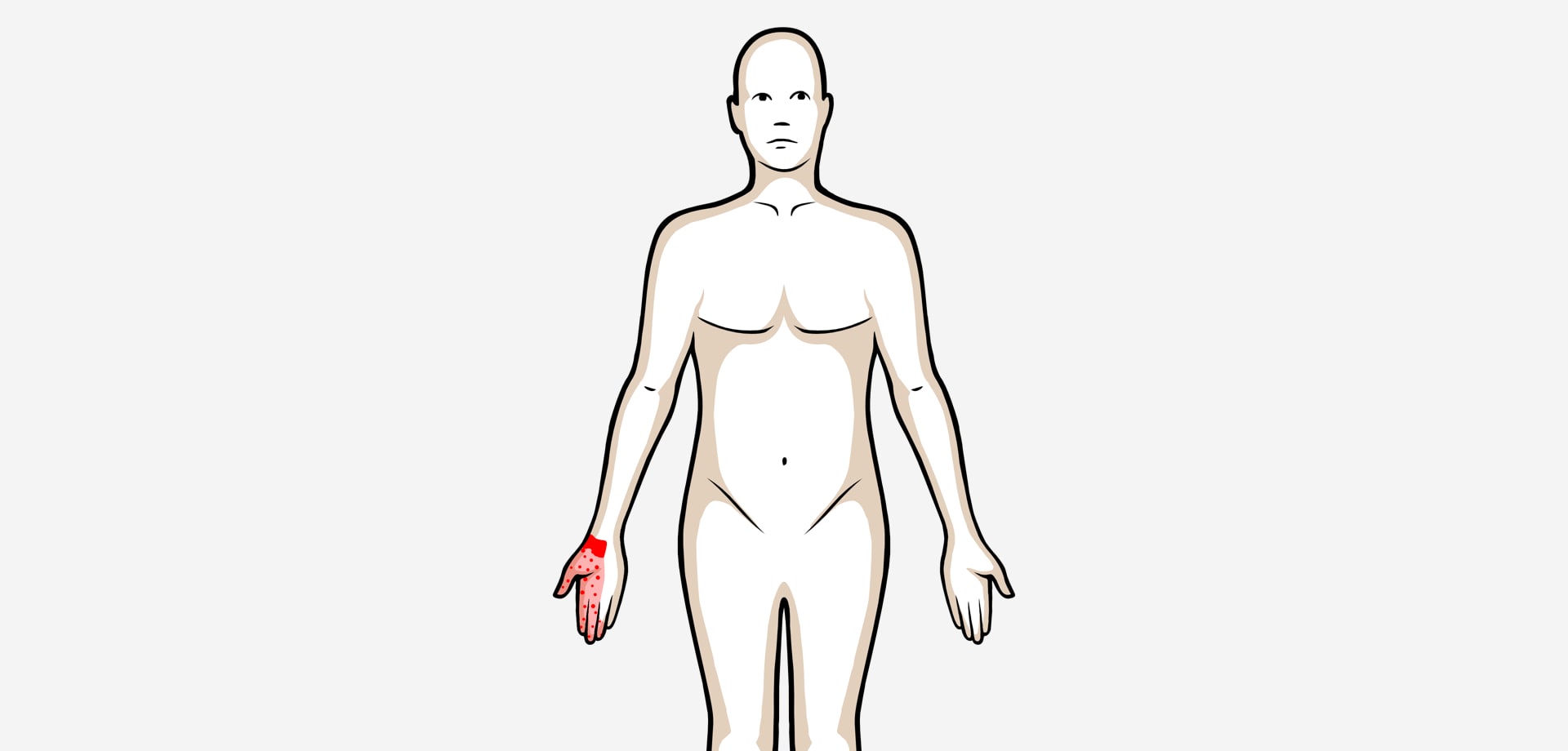 Ardor y hormigueo en pulgar e índice